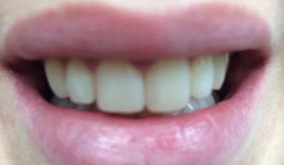 Esthetische tandheelkunde na
